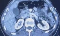 Uyuşturucuyu midelerinde getiriyorlardı: Yakalandılar