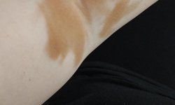 Özel hastanede serum skandalı iddiası