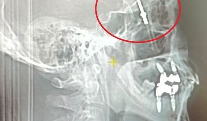 Beynine saplanan implant hayatını kararttı