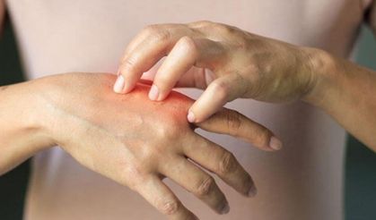 Çocuklarda egzama ve kaşıntı